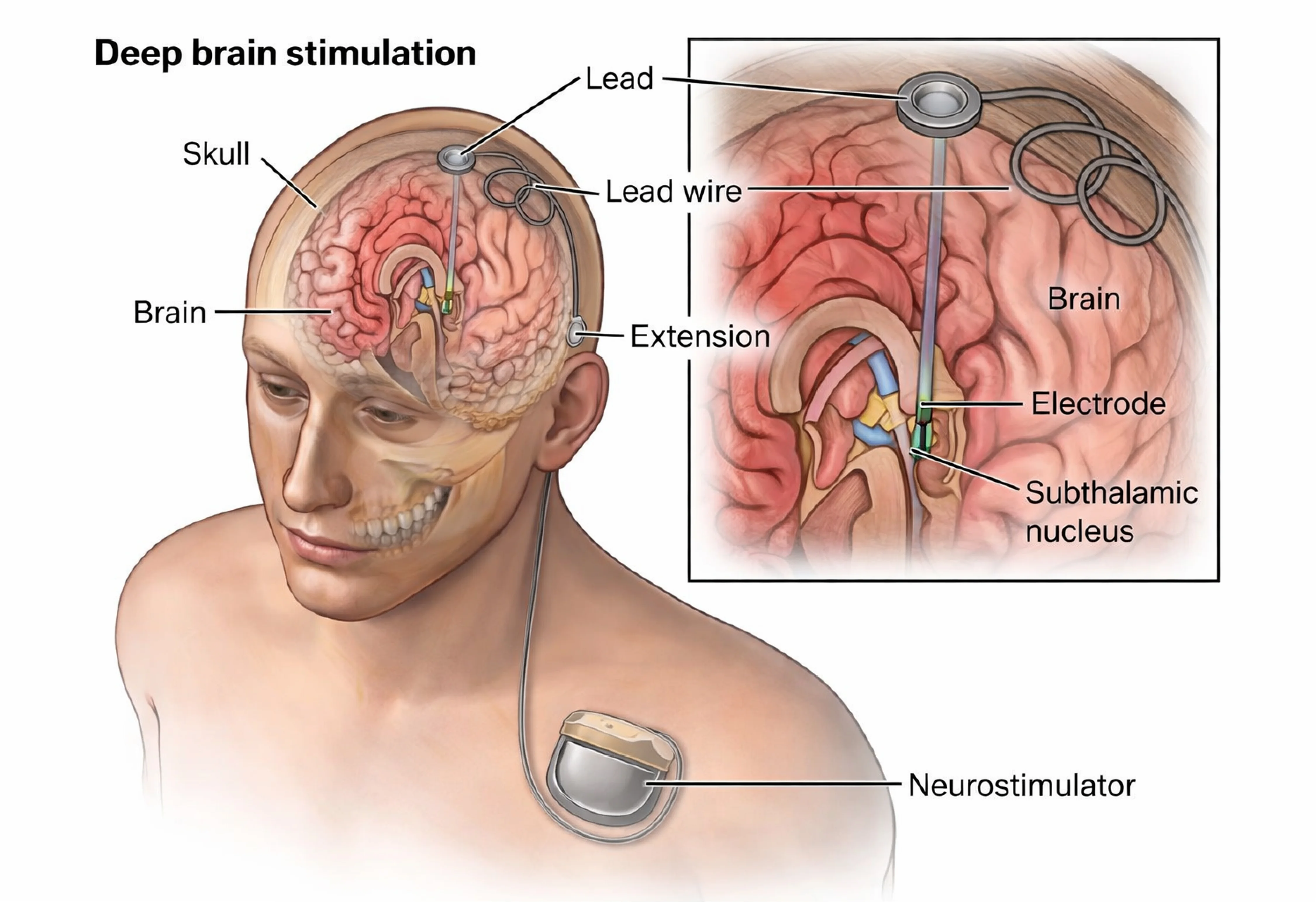 Deep Brain Stimulation (DBS).webp
